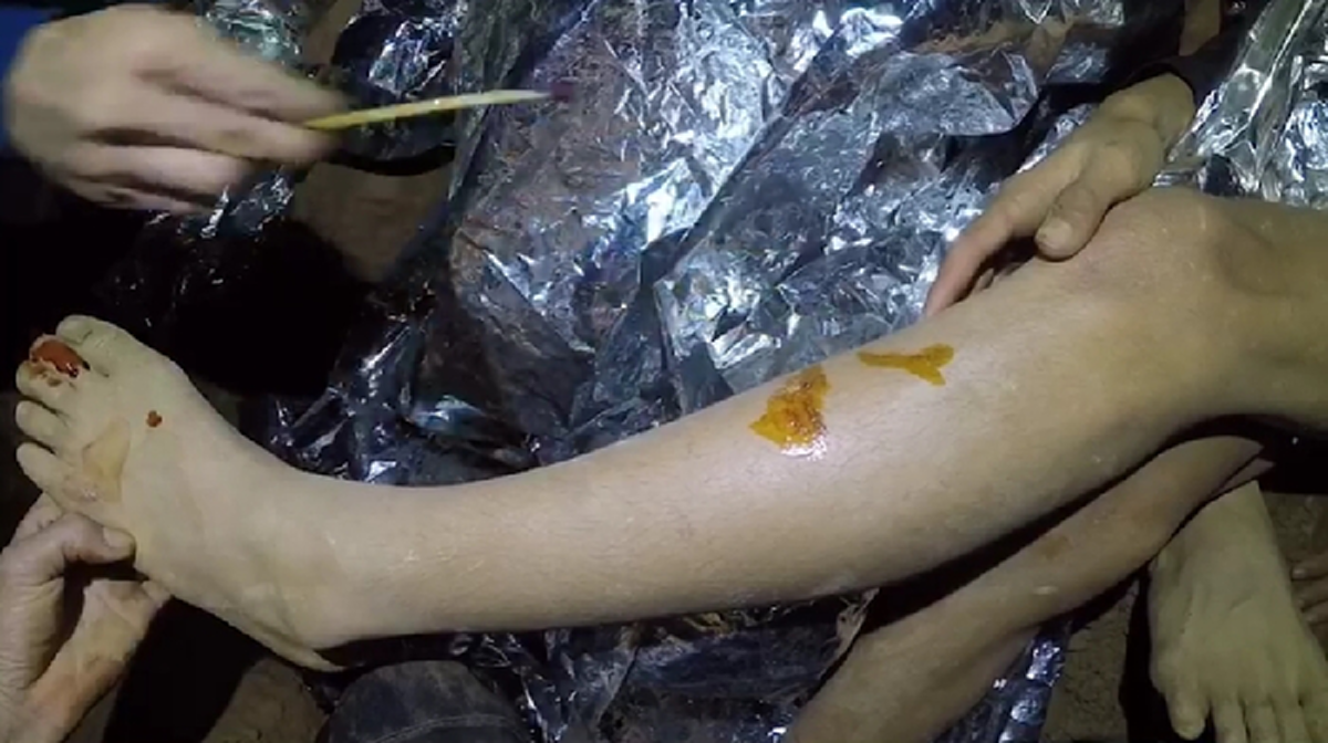 แผลอยู่ตรงไหนน้องๆ !!! คลิป “หมอภาคย์” กำลังทำแผลให้ “ทีมหมูป่าถ้ำหลวง” พูดคุยยิ้มแย้ม มีแซว ...เดี๋ยวออกไปข้างนอกเจอพยาบาลสวยๆ !! (มีคลิป)