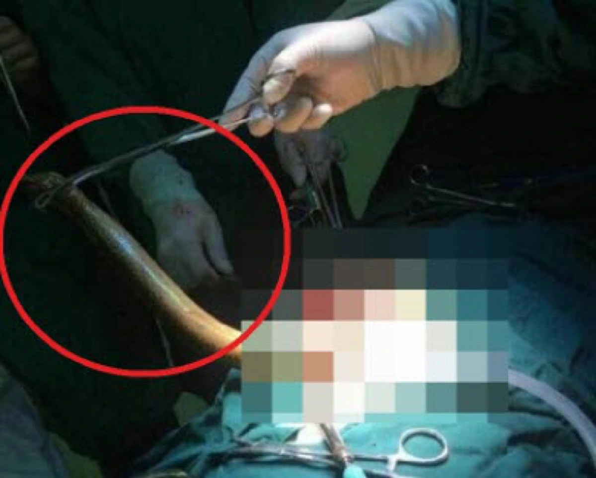 #ช็อกคาห้องผ่าตัด!! "หญิงสาว" อยากขึ้นสวรรค์ "ใช้ปลาไหลช่วยตัวเอง" พลาดเข้าช่องคลอด ชาวบ้านหอบร่าง หามส่งแทบไม่ทัน !! (ชมคลิป)