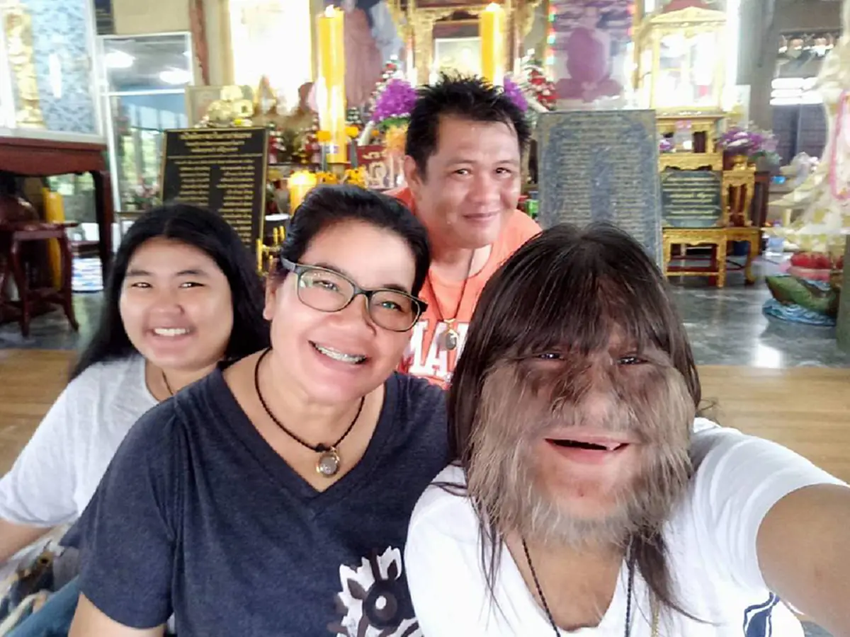 #ฮือฮาสนั่นโซเชียล!! เปิด ภาพล่าสุด "น้องแนท" เด็กขนยาว โตเป็นสาววัย 17 ไม่มีขนบนหน้าแล้ว พ่อค้นพบวิธีการขจัดแบบใหม่ ที่ไม่ใช่การเลเซอร์ !!