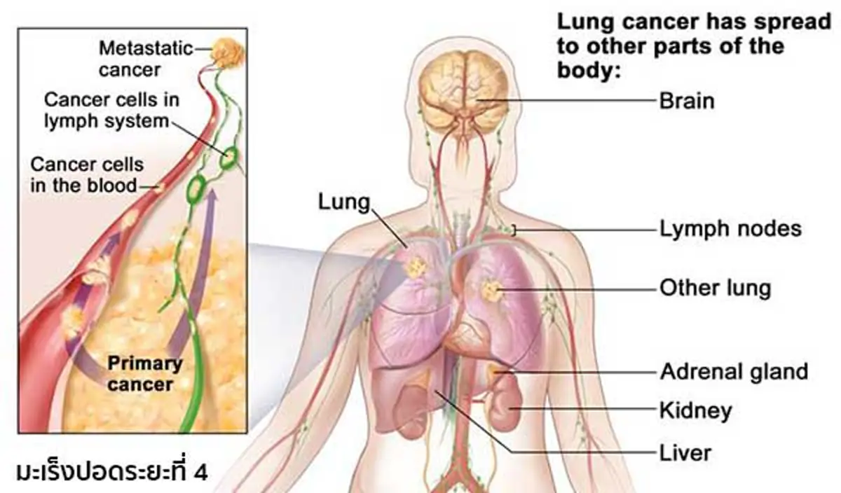 เป็นได้แม้ไม่เสี่ยง!!! เพียงใช้ชีวิตประจำวันผิดๆ คุณก็เสี่ยงเป็นมะเร็งปอดโดยไม่รู้ตัว อ่านก่อน รู้ทัน ป้องกันได้!!!
