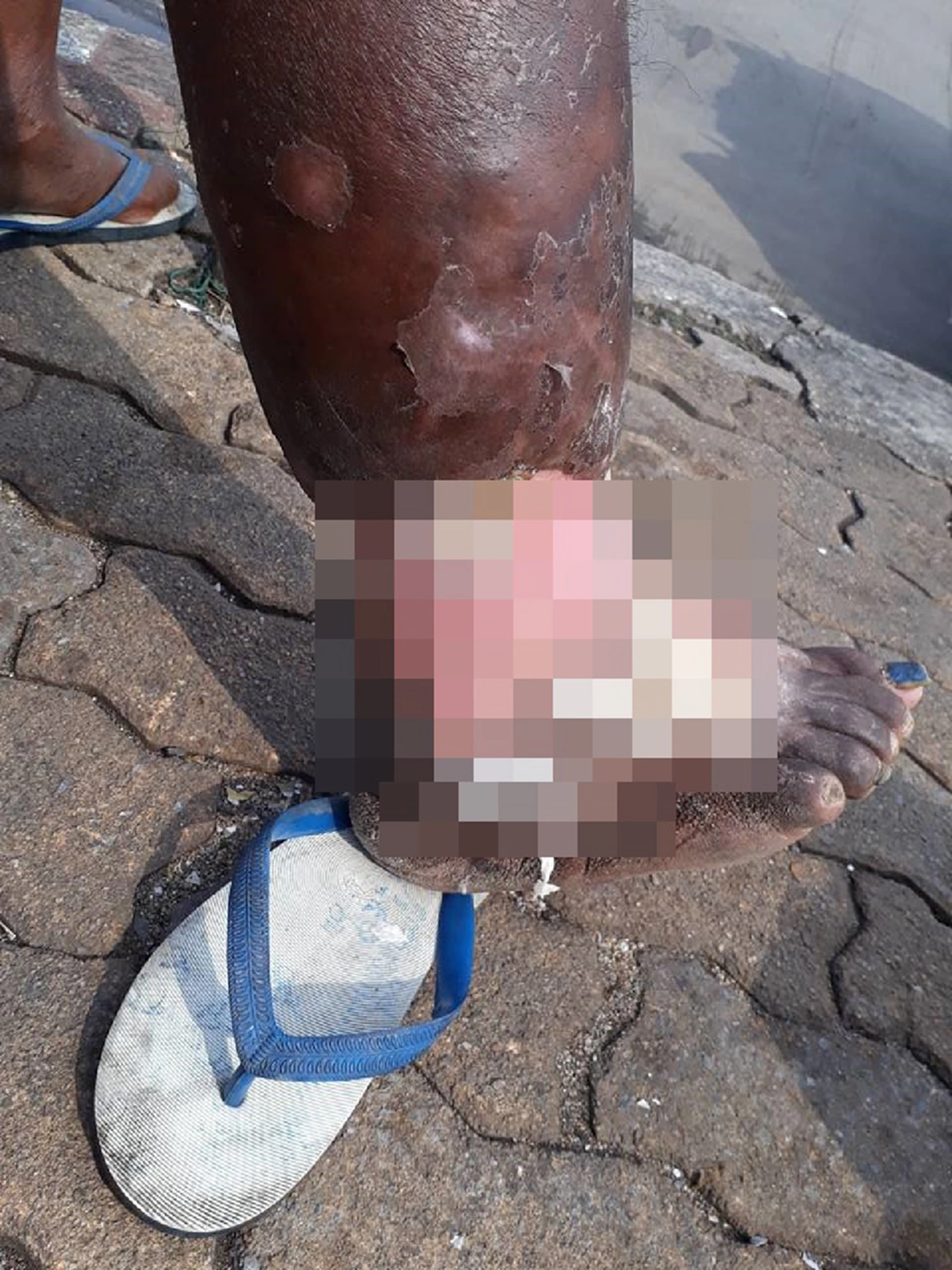 จิตอาสามันอยู่ที่ใจ!! แห่ชื่นชม หนุ่มใจงามเจอคุณลุงป่วยเป็นโรคเท้าช้างมีแผลเปื่อย รีบเข้าไปช่วยล้างแผลให้ฟรีๆโดยไม่มีท่าทีรังเกียจ (คลิป)