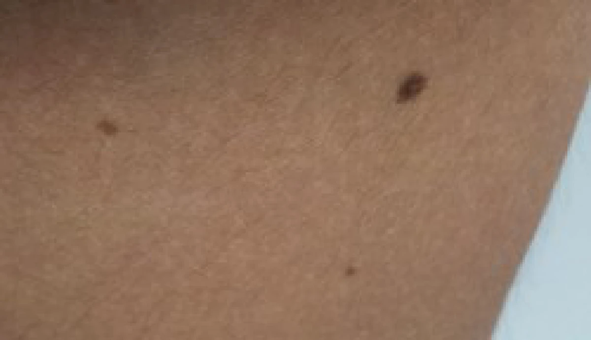 รู้แล้วบอกต่อ!! วิธีกำจัด ไฝ ขี้แมลงวัน แสนง่ายที่ทำเองได้ราคาสบายกระเป๋า