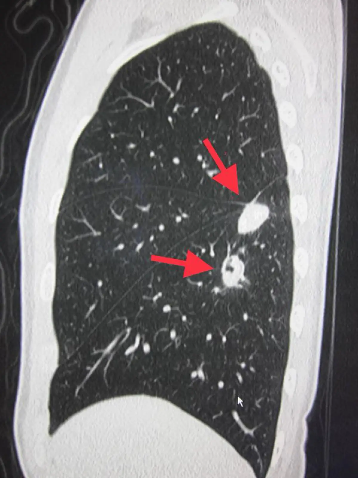 น่ากลัวต้องอ่าน!! คุณหมอเตือน การสูดดมเห็ดสด และอยู่ใกล้นกพิราบ นั้นอันตราย