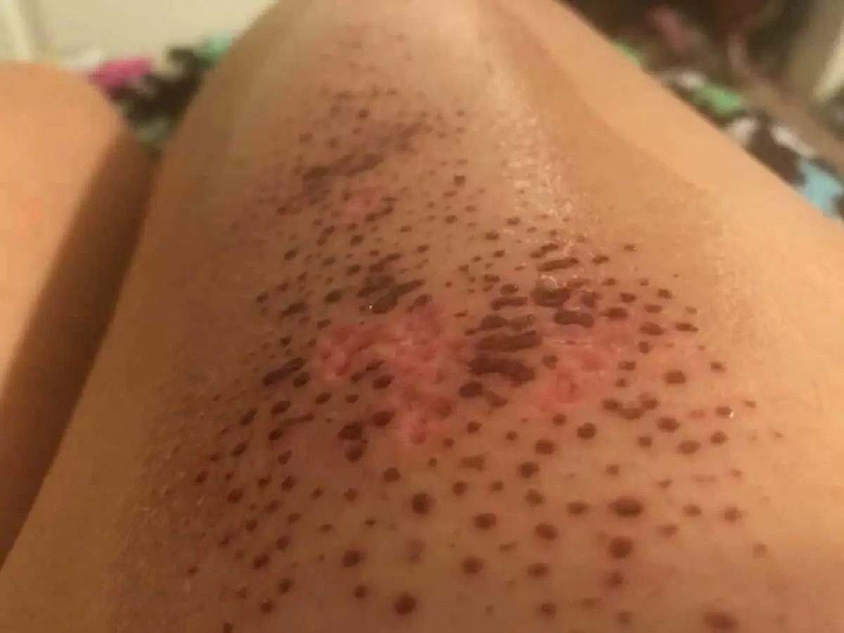 อันตรายกว่าที่คิด !!! เคสมือถือสุดฮิตทำพิษ ใช้เเล้วผิวหนังพุพอง น่าสยดสยอง !!!