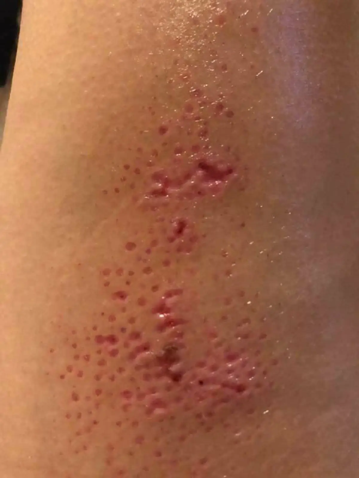 อันตรายกว่าที่คิด !!! เคสมือถือสุดฮิตทำพิษ ใช้เเล้วผิวหนังพุพอง น่าสยดสยอง !!!