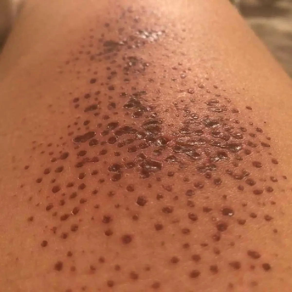 อันตรายกว่าที่คิด !!! เคสมือถือสุดฮิตทำพิษ ใช้เเล้วผิวหนังพุพอง น่าสยดสยอง !!!