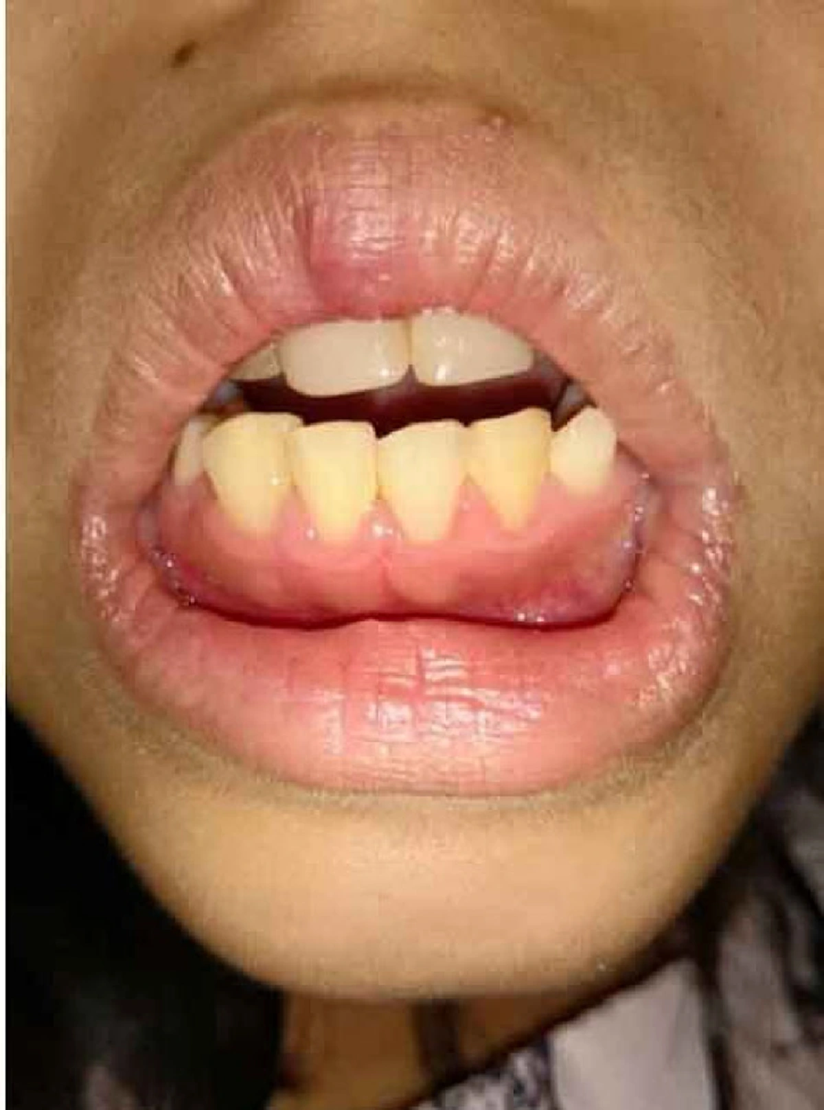 ผมนี่อึ้งไปเลย!! "ฟันหัก-หลุด" อย่าทิ้ง!! กลับเอามาต่อใหม่ได้!! ด้วยวิธีสุดทึ่ง?? บอกเลยแทบไม่เชื่อสายตาตัวเอง!!