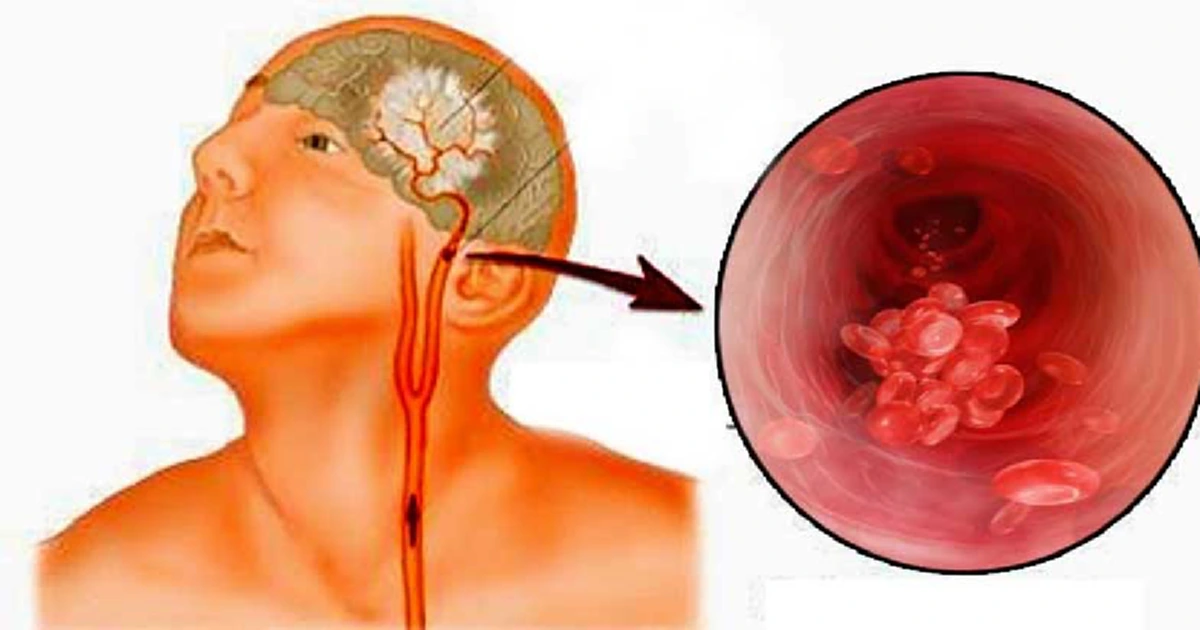 มหัศจรรย์มากๆ! สุดยอดวิธีกำจัดขี้หูออกไป ไม่ให้อุดตันอยู่ในหูอีกต่อไป