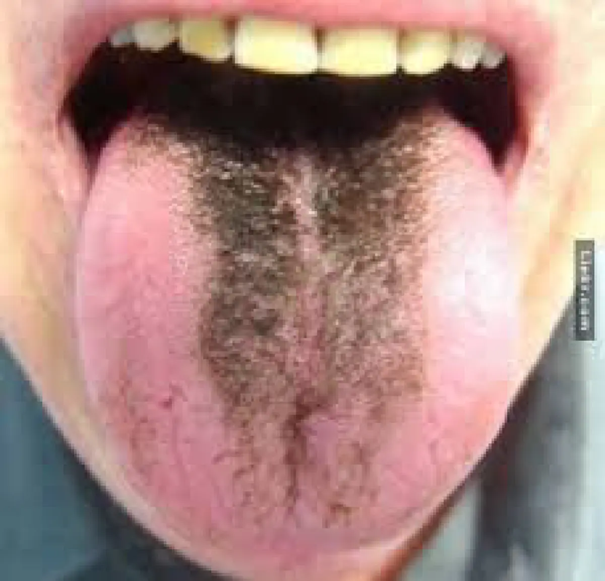 สังเกตุให้ดี!! #สีของลิ้น คือสัญญาณเตือนภัยและสามารถบอกโรคได้  รีบส่องกระจกแล้วเช็คเลย!!