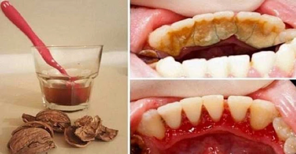 ง่ายมากๆ !! แค่ทำตามวิธีนี้ คราบแบคทีเรีย และหินปูน จะหมดไปแบบถาวร