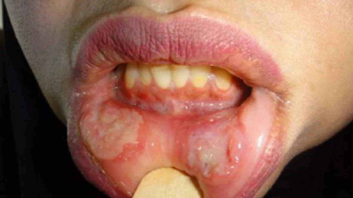 แผลในปาก