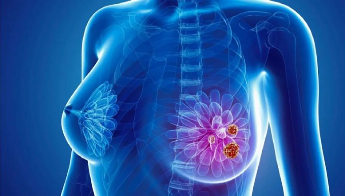 แพทย์เตือน!!! มะเร็งเต้านมเป็นได้ทั้งชายหญิง!!! ไม่อยากเป็นมะเร็งเต้านมต้องอ่าน!!!