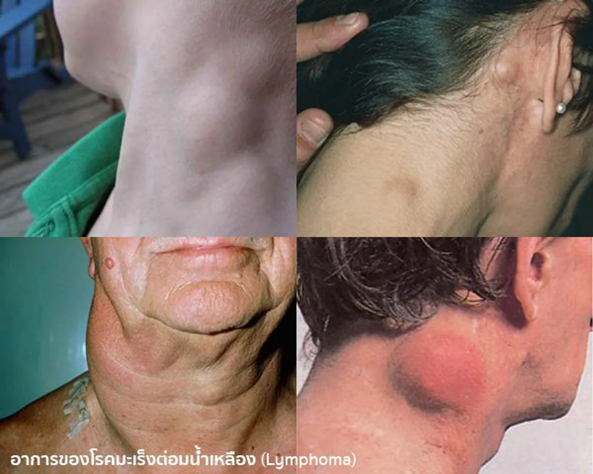 อย่ามองข้าม!!! 12 สัญญาณมะเร็งต่อมน้ำเหลือง ไม่ใช่เรื่องไกลตัว รู้ก่อนโอกาสรอดสูง!!!