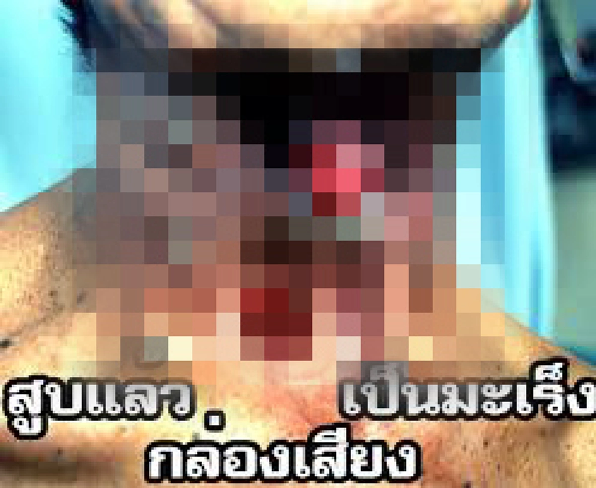 ระวัง!!! พฤติกรรมประจำวันส่งสัญญาณเสี่ยงมะเร็งลำคอโดยไม่รู้ตัว!!!