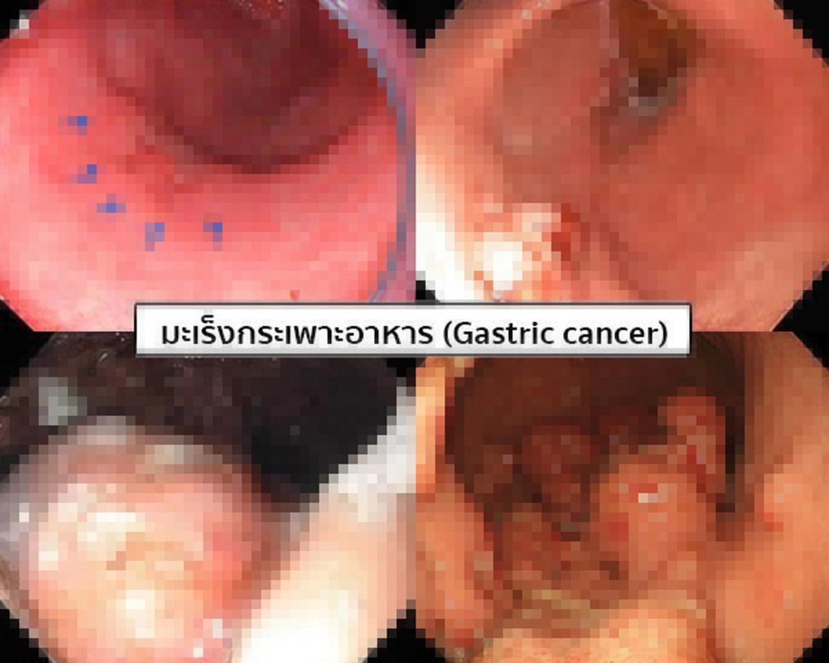แพทย์เตือน!!! เอเชียเสี่ยงมะเร็งกระเพาะอาหารมากกว่าชาติอื่น ภัยเงียบที่หลายคนมองข้าม อ่านก่อน รู้อาการ รับมือทัน!!!