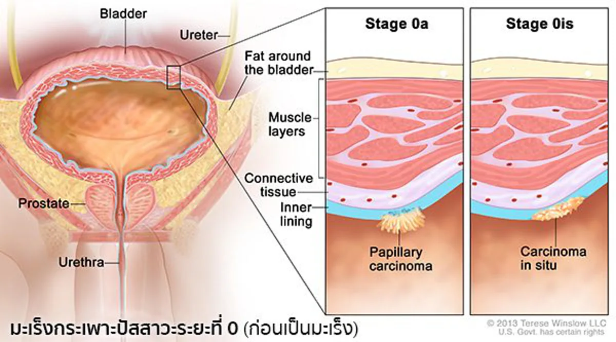 แพทย์ย้ำ!!! มะเร็งกระเพาะปัสสาวะพบบ่อยในไทย ไม่มีปัจจัยเสี่ยงก็เกิดโรคได้!!!