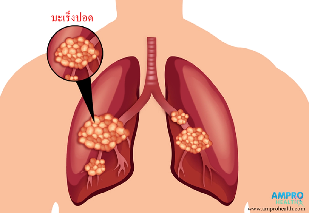 เป็นได้แม้ไม่เสี่ยง!!! เพียงใช้ชีวิตประจำวันผิดๆ คุณก็เสี่ยงเป็นมะเร็งปอดโดยไม่รู้ตัว อ่านก่อน รู้ทัน ป้องกันได้!!!