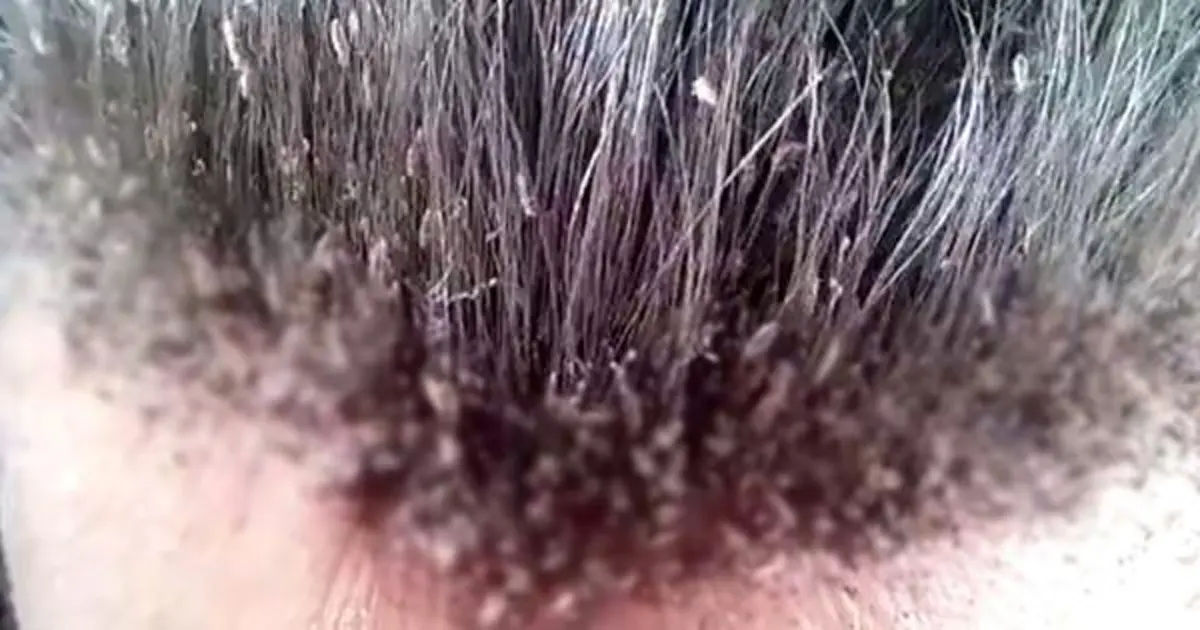 ไม่ต้องรอถึงมือหมอ !! เผย "วิธีรักษาเหา" ที่ได้ผลดีสุดๆ โดยไม่ต้องพึ่งหมอ !!!