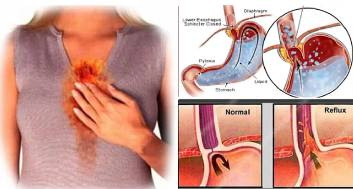 มนุษย์เงินเดือนต้องรู้!!! “โรคกระเพาะกรดไหลย้อน” ภัยเงียบโรคออฟฟิศซินโดรมสำหรับคนทำงานยุคนี้