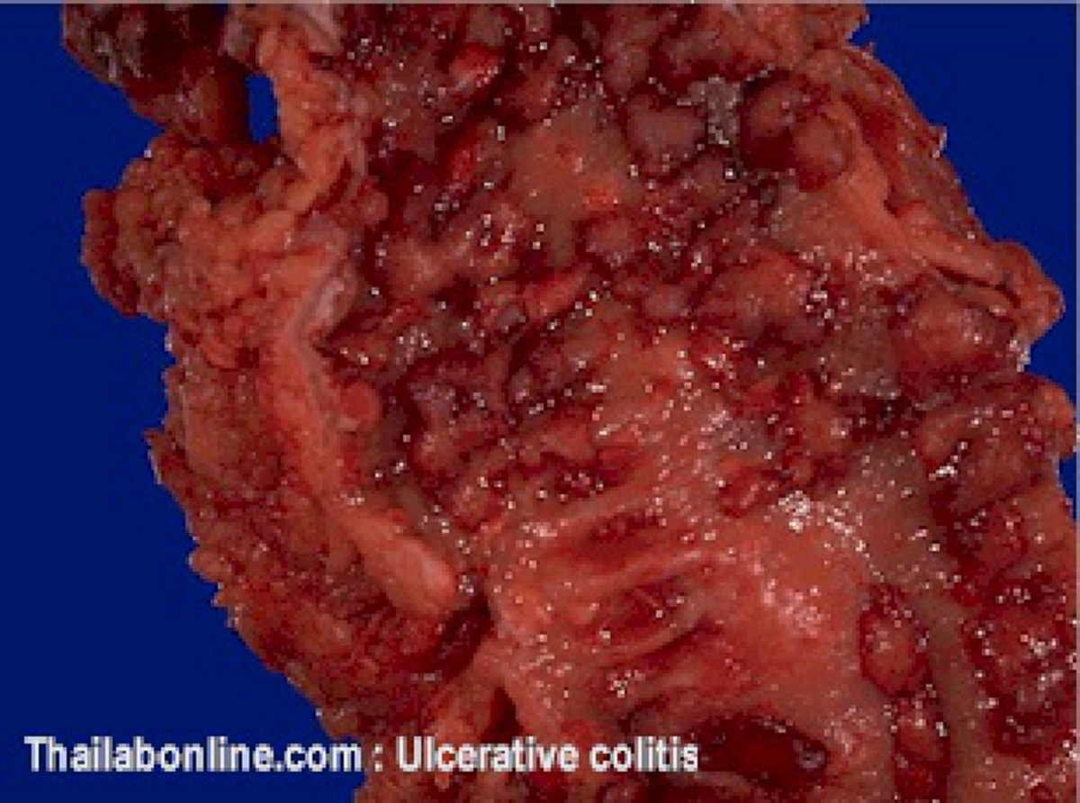 อันตราย!!! สสส.ย้ำ ปวดท้องใต้ซี่โครงขวา เสี่ยงอันตราย อย่าประมาท!!!