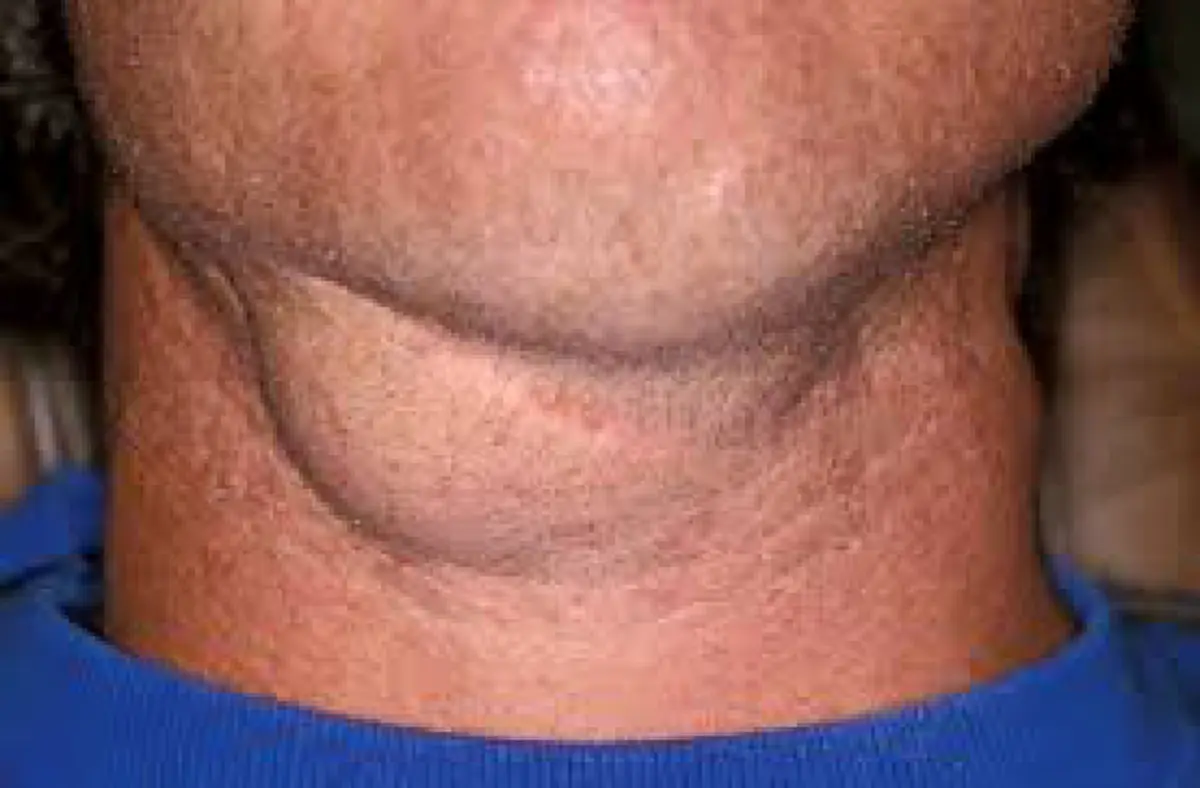 ระวัง!!! พฤติกรรมประจำวันส่งสัญญาณเสี่ยงมะเร็งลำคอโดยไม่รู้ตัว!!!