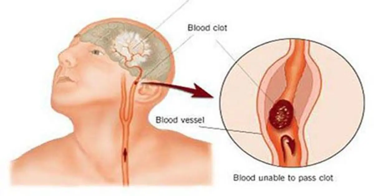 อย่าละเลย 6 สัญญาณเตือนที่แสดงให้รู้ว่า..คุณอาจมีลิ่มเลือดที่ทำให้เส้นเลือดอุดตัน บอกเลยอันตรายถึงชีวิต!!!
