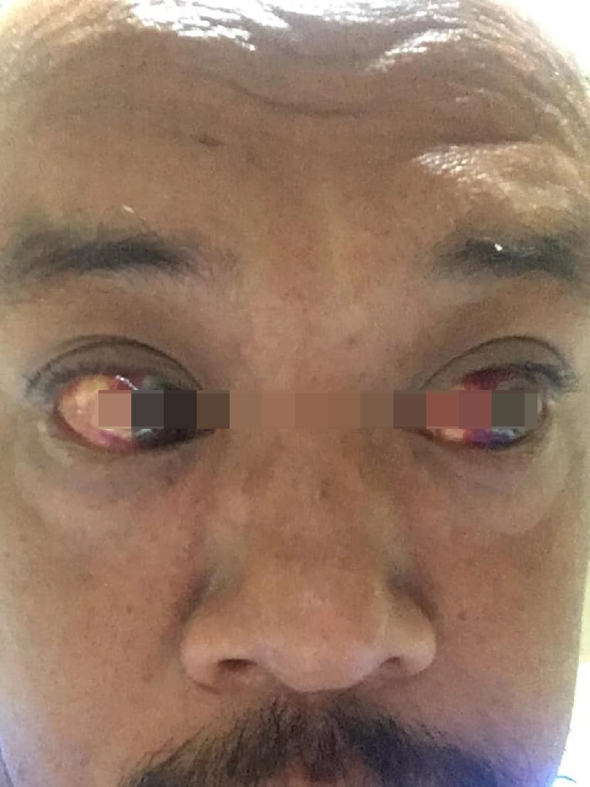 โดนผึ้งต่อยที่ลิ้นไก่