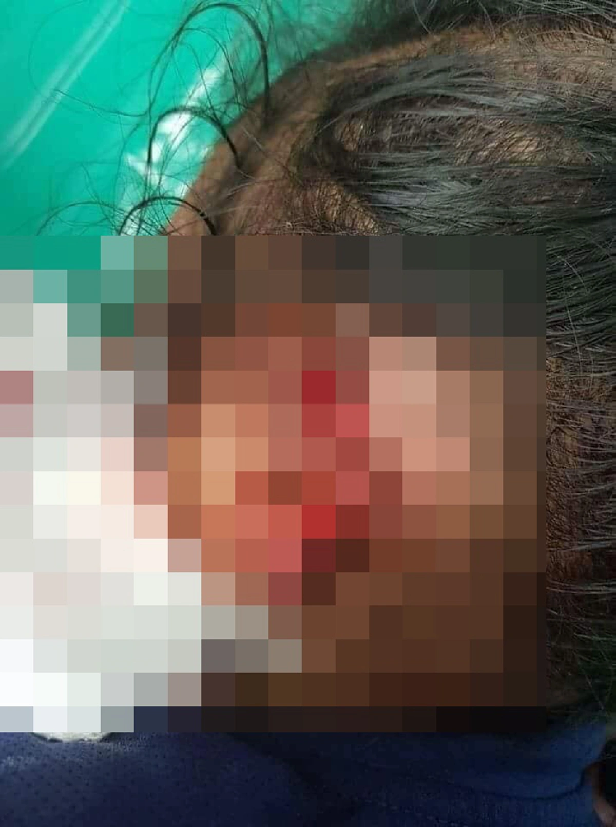 บ่อยเกินไปแล้ว ด.ญ.วัยแค่ 4 ขวบเดินตามยายทวดไปเก็บผัก โดนหมาบางแก้วกระโจนกัดเจ็บสาหัส