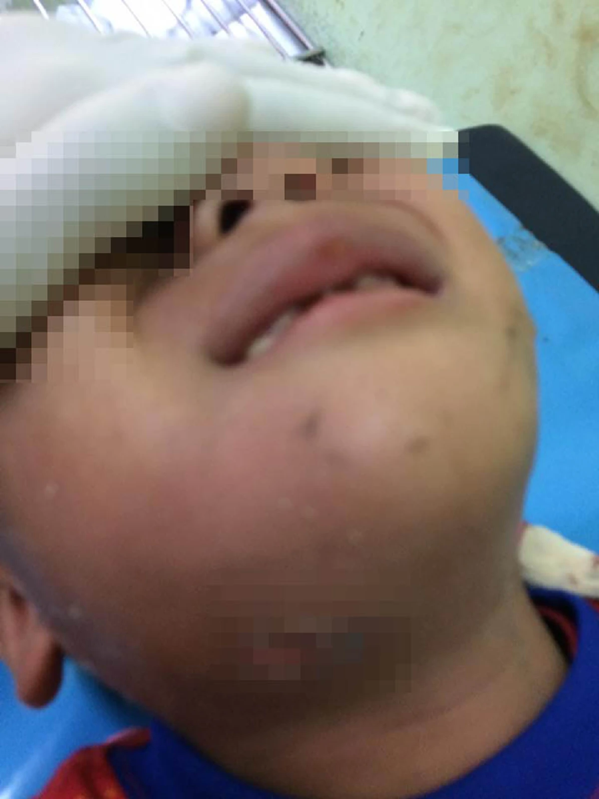 กรณีเจาะคอระบายหนอง