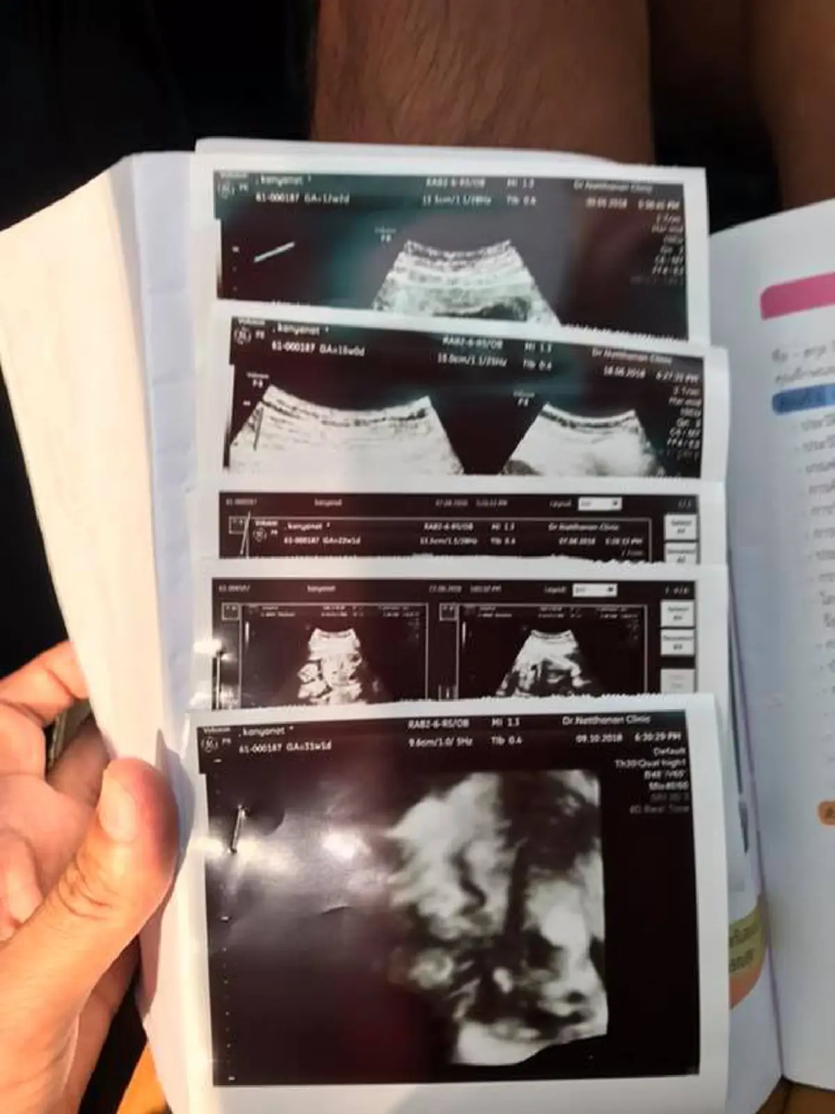 หนุ่มโพสต์สะเทือนใจ หลัง ภรรยาครรภ์เป็นพิษจนเสียชีวิต หมอพูดเพียงสั้นๆ อื้ม...ปัดความรับผิดชอบหรือไม่