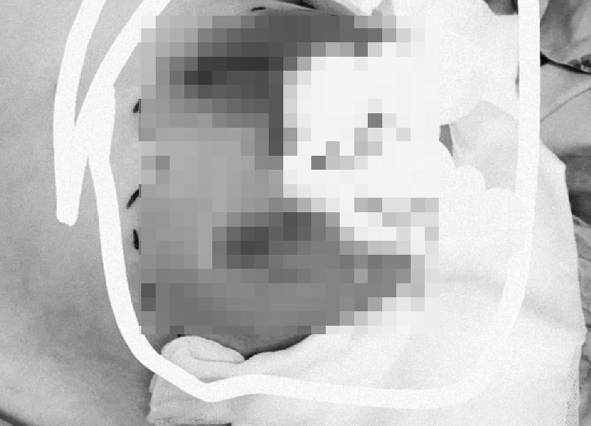 สาวดูดไขมันพร้อมฉีดเสริมหน้าอก คลินิกทำพลาดมีไขมันของเก่าปะปนสุดท้ายเน่าติดเชื้อ!