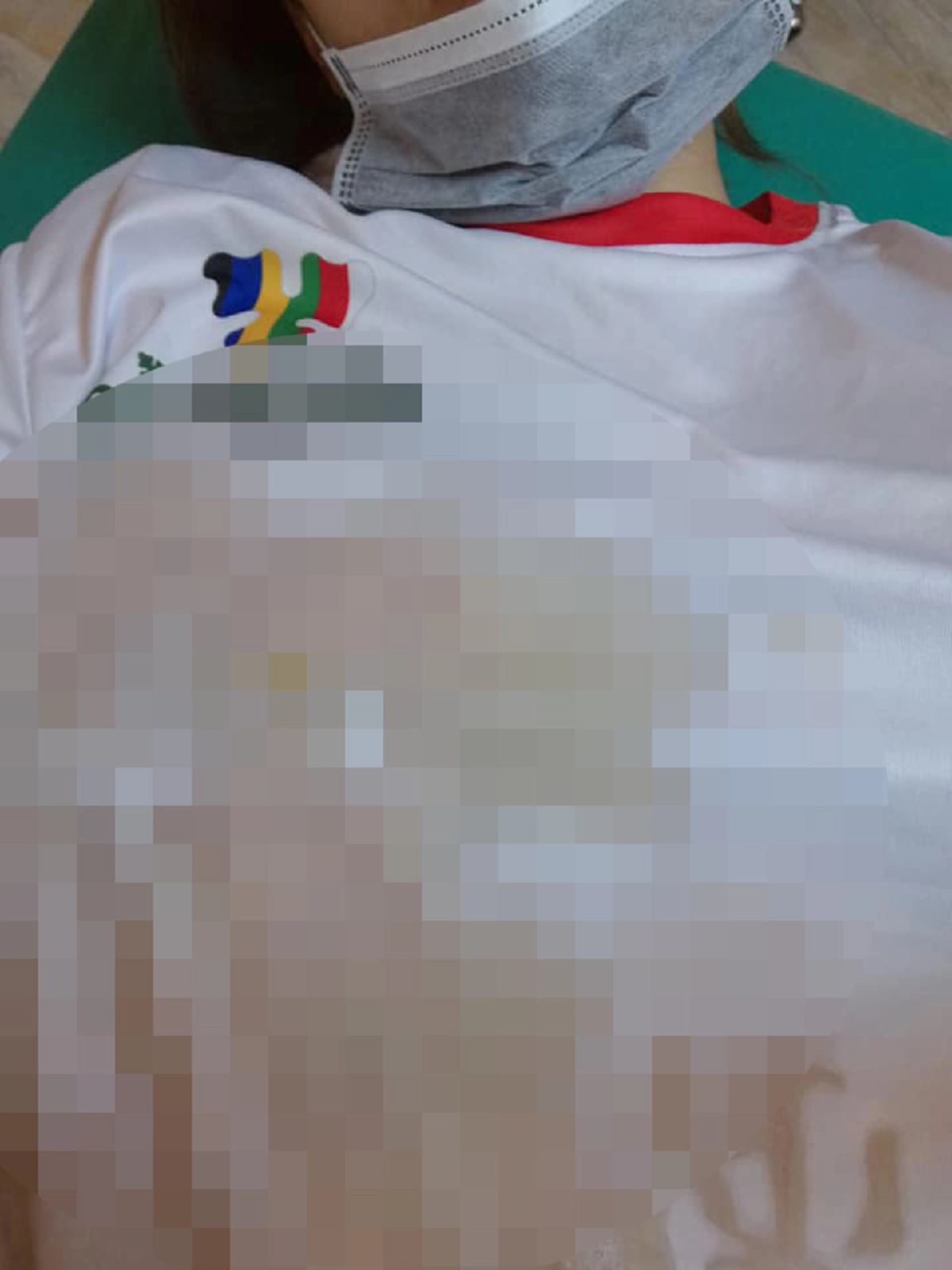 สาวดูดไขมันพร้อมฉีดเสริมหน้าอก คลินิกทำพลาดมีไขมันของเก่าปะปนสุดท้ายเน่าติดเชื้อ!