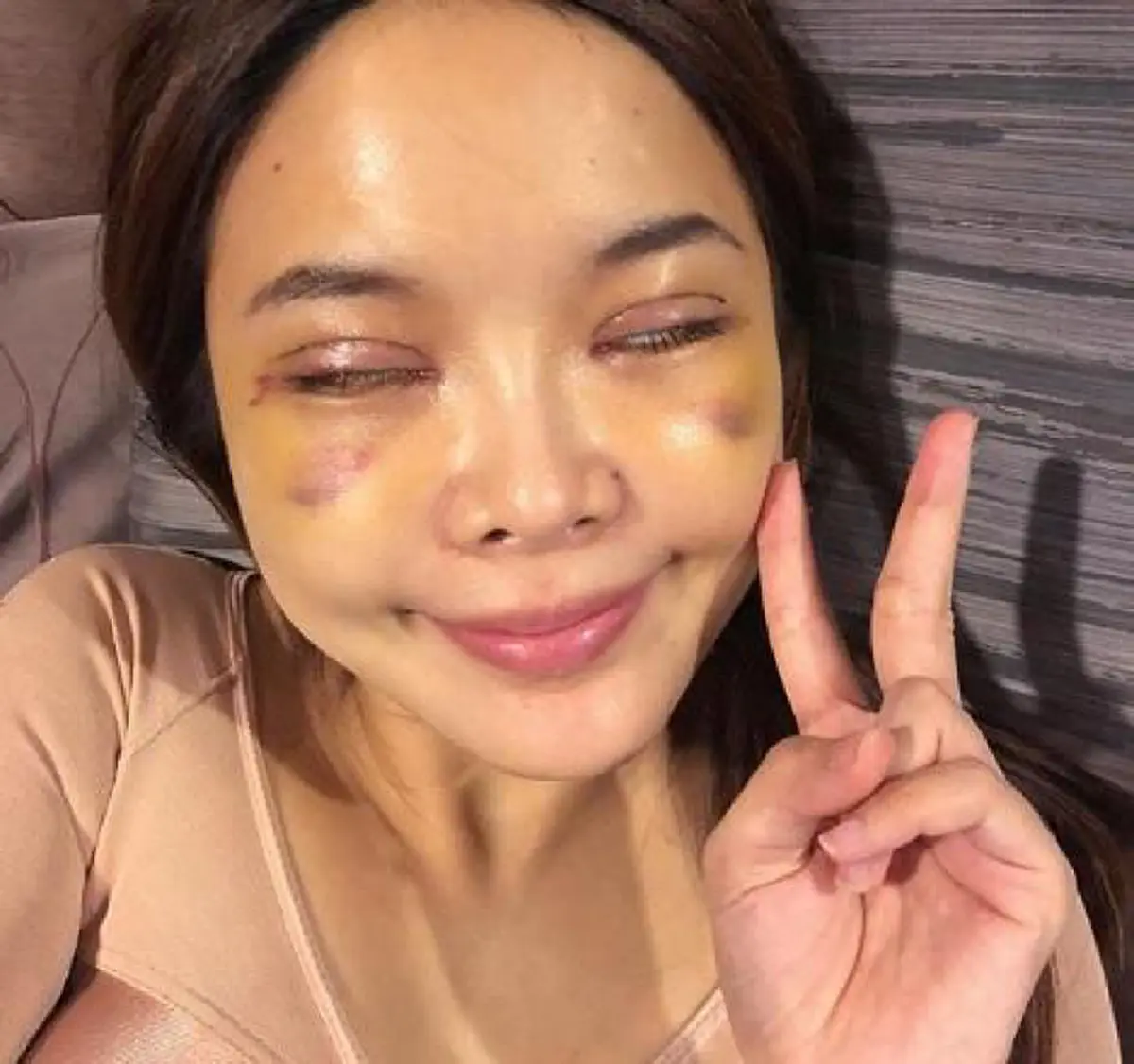 เริ่มดีขึ้นแล้ว! ส่องภาพ "หญิงแย้" อัพเดตร่างกายล่าสุด หลังทำศัลยกรรมทั้งตัว ไม่ได้อาบน้ำมา 15 วัน! (ชมคลิป)