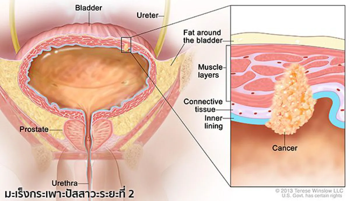 แพทย์ย้ำ!!! มะเร็งกระเพาะปัสสาวะพบบ่อยในไทย ไม่มีปัจจัยเสี่ยงก็เกิดโรคได้!!!
