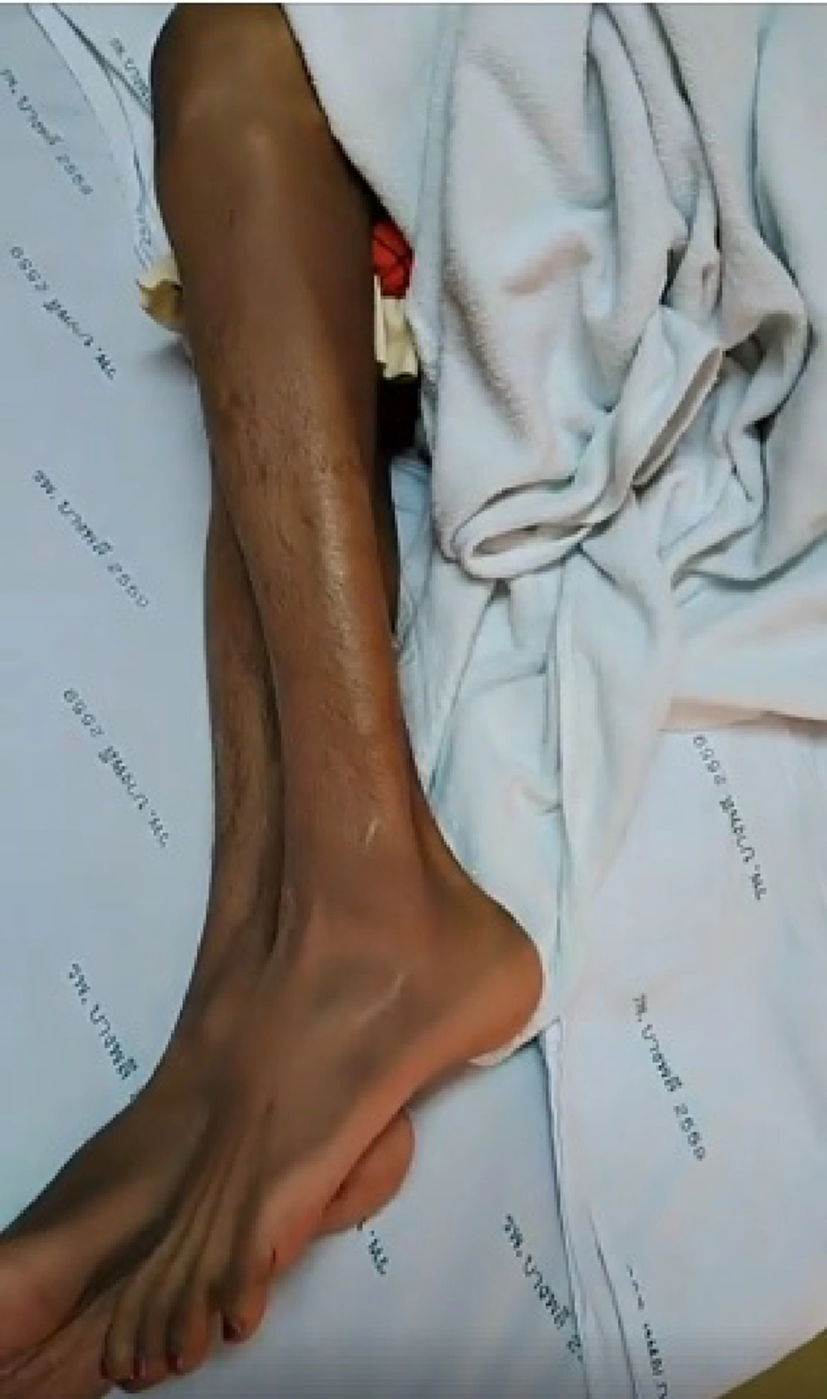 "ไข่มุก ซุปตาร์" ตลกดังป่วยมะเร็ง ล่าสุดขาเริ่มลีบ ไม่มีเงินรักษาตัวเเล้ว