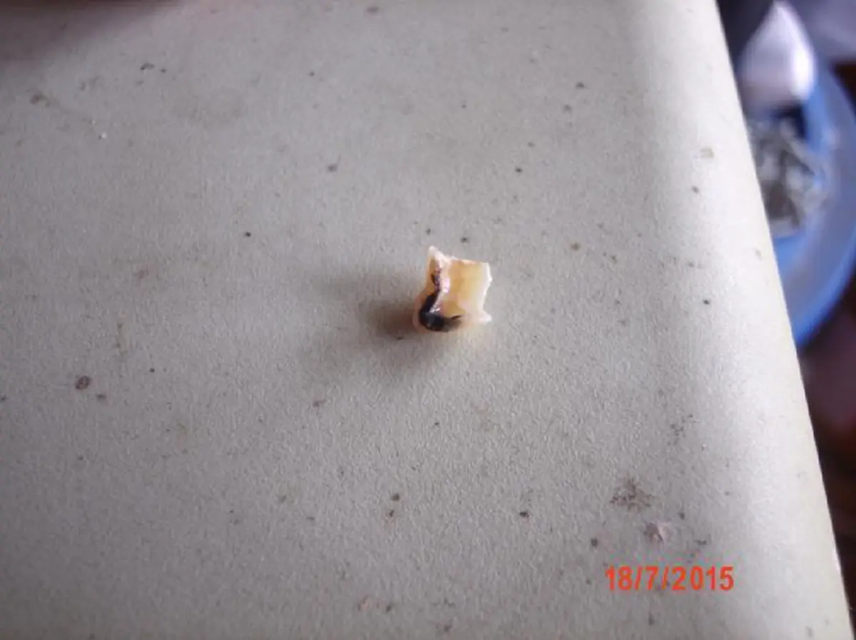 ไม่อยากตายเพราะฟันซี่เดียว ต้องอ่าน!! อุทาหรณ์ "หนุ่มฟันผุหนัก" แต่ไม่ยอมหาหมอ ท้ายที่สุดสิ่งที่เขารากฟันตายเกลี้ยงทั้งปาก !!  (มีภาพ)