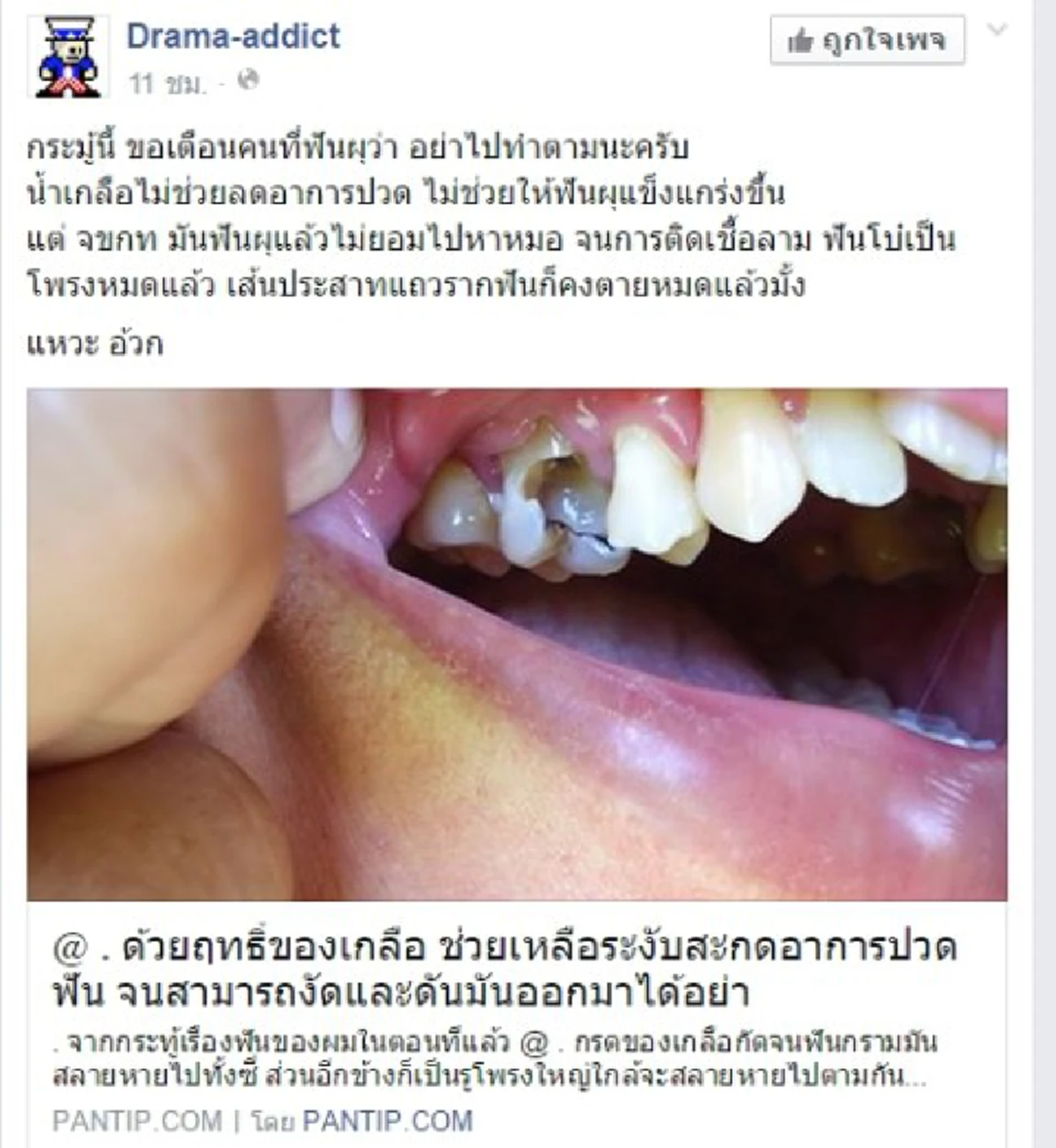 ไม่อยากตายเพราะฟันซี่เดียว ต้องอ่าน!! อุทาหรณ์ "หนุ่มฟันผุหนัก" แต่ไม่ยอมหาหมอ ท้ายที่สุดสิ่งที่เขารากฟันตายเกลี้ยงทั้งปาก !!  (มีภาพ)