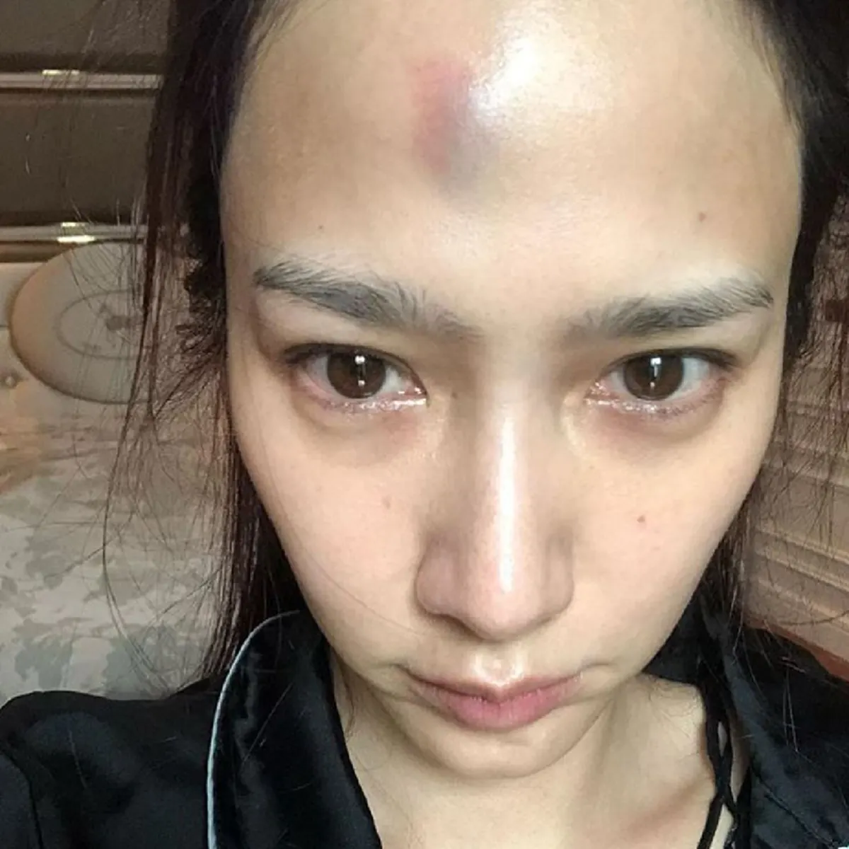 ตื่นเช้ามารับโชคใหญ่!! "อั้ม พัชราภา" โพสต์ภาพหน้าผากตัวเอง มีรอยแผลฟกช้ำ ส้นตู้ตกใส่หน้าผาก ส่งสติ๊กเกอร์ร้องไห้อยากเอาตู้มาทำลาย