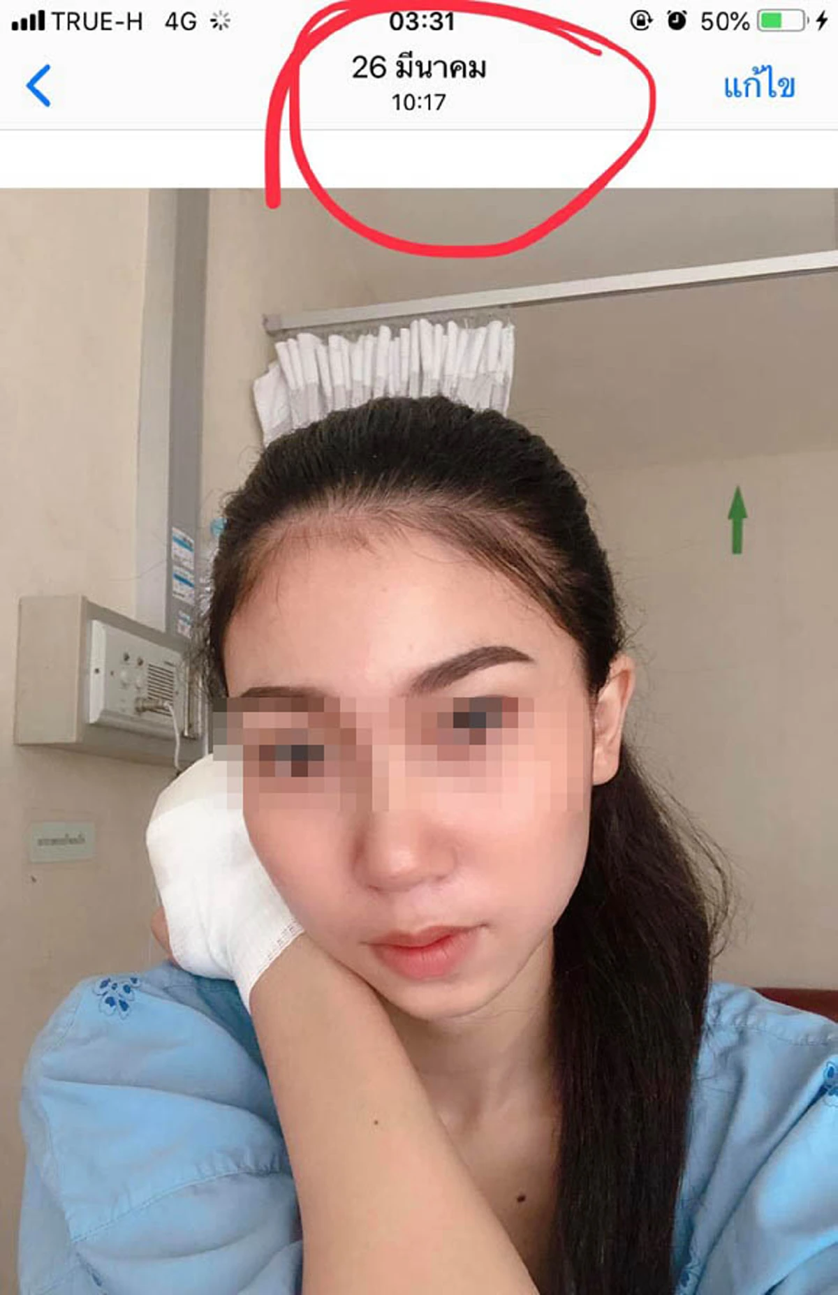 นักศึกษาปี4ไปฝึกงานโรงแรมเกิดเหตุต้องสละอวัยวะเพื่อรักษาชีวิต
