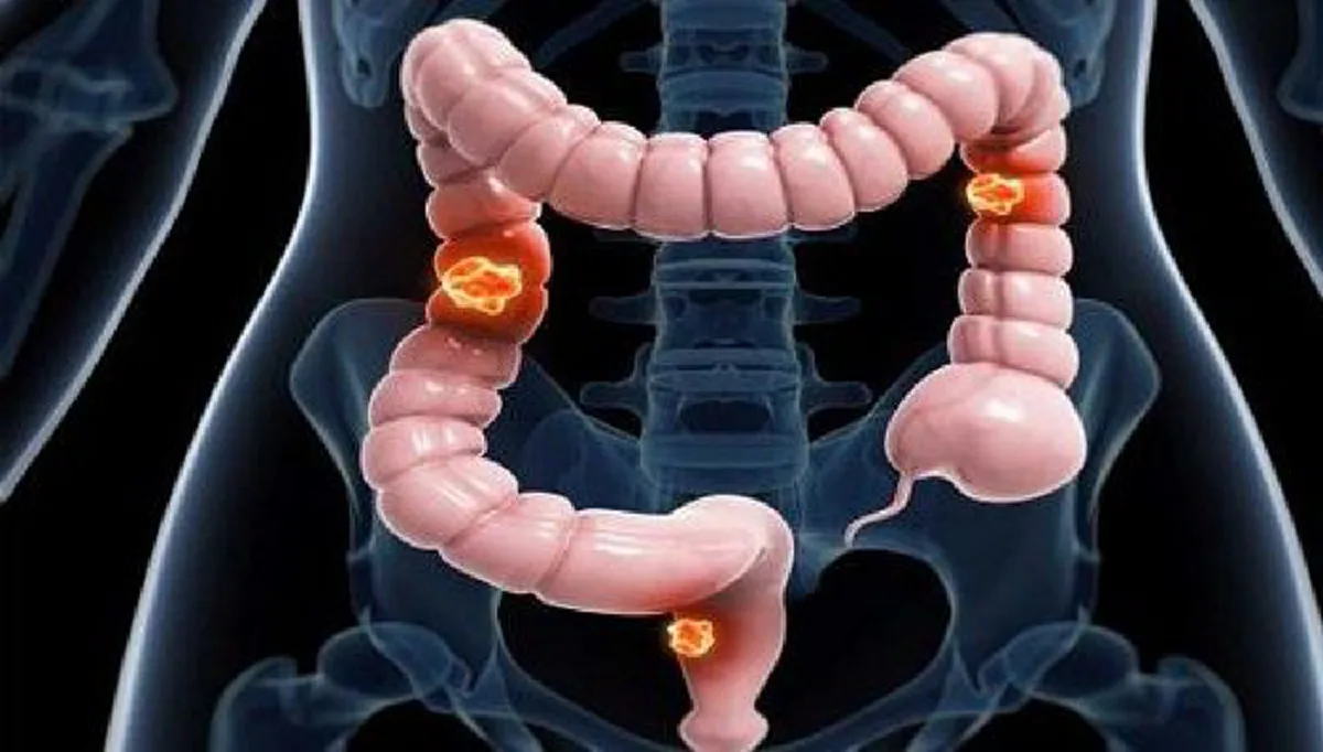 คนทำงานอ่านด่วนๆ!!! มะเร็งลำไส้ เพชฌฆาตในเงามืด โรคร้ายที่ต้องระวัง!!!