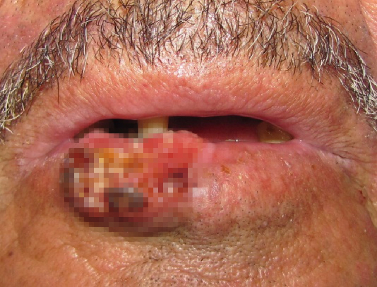 อย่าชะล่าใจ!!! ระวังเสี่ยงมะเร็งช่องปากโดยไม่รู้ตัว เช็คด่วนคุณคือหนึ่งไหนกลุ่มเสี่ยงหรือไม่!!!