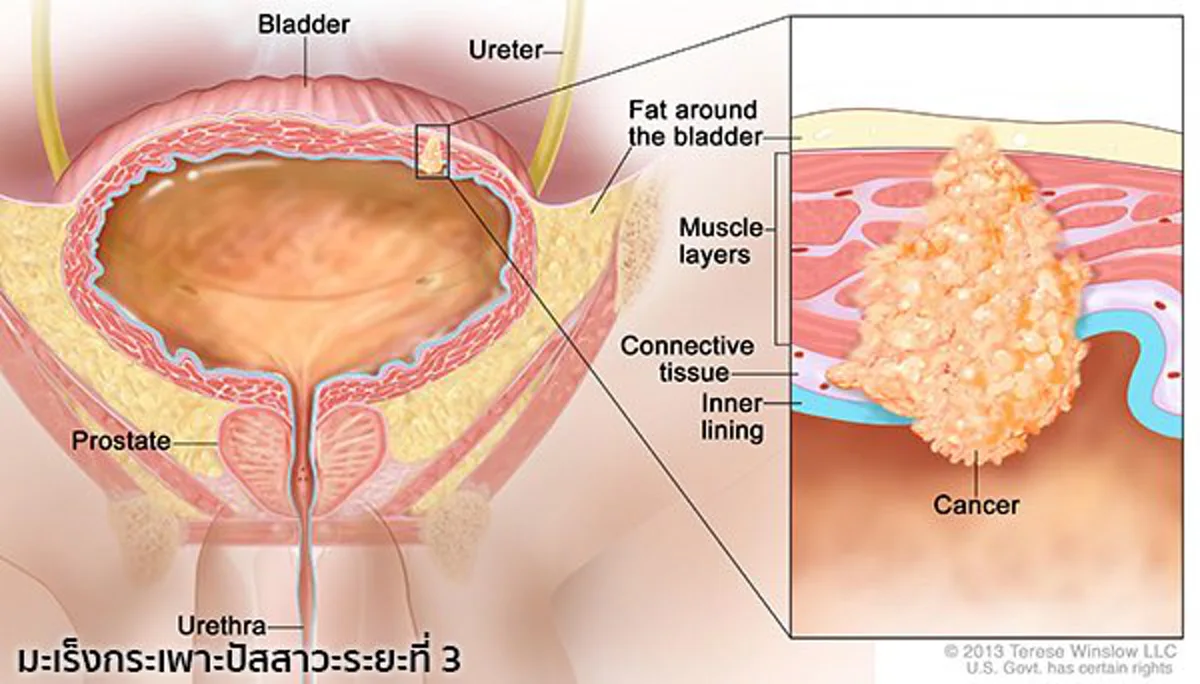 แพทย์ย้ำ!!! มะเร็งกระเพาะปัสสาวะพบบ่อยในไทย ไม่มีปัจจัยเสี่ยงก็เกิดโรคได้!!!