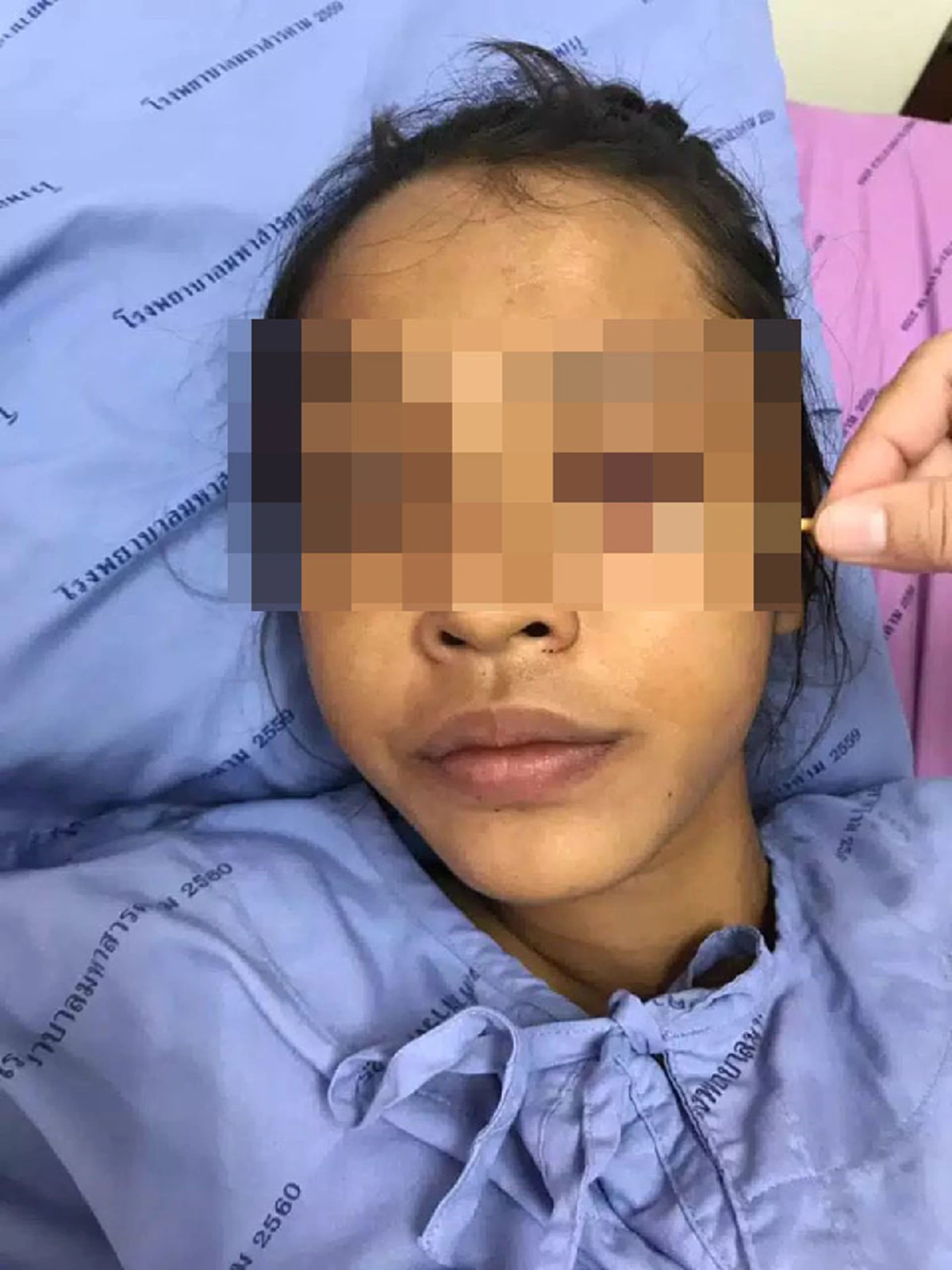 อาการล่าสุดนร.หญิง แนวโน้มตาบอดถาวร