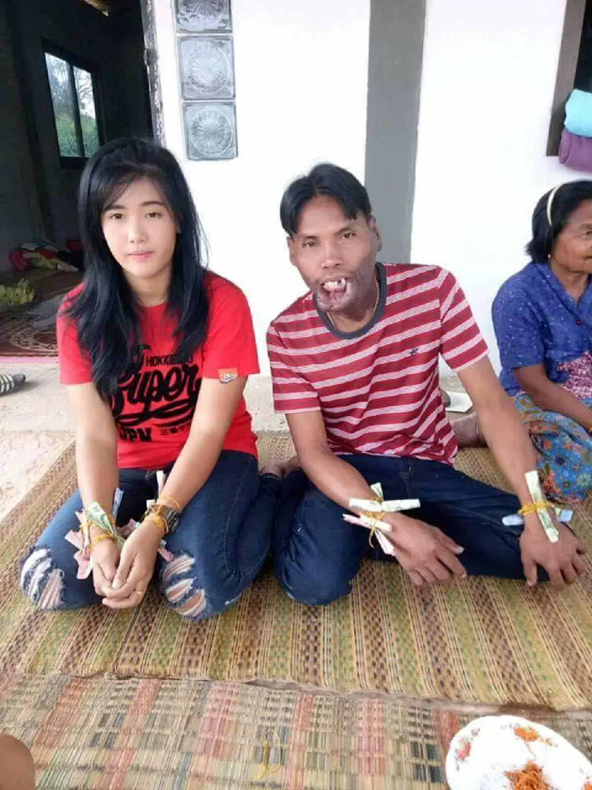 #ใกล้ถึงเวลาได้ชีวิตใหม่!! เปิดภาพล่าสุด “มีมี่ หนุ่มหน้าปาน” หลังขึ้นเขียงผ่าตัดครั้งแรก แฟนคลับแห่คอมเม้นท์สนั่น เตรียมตัวหล่อได้เลย!!