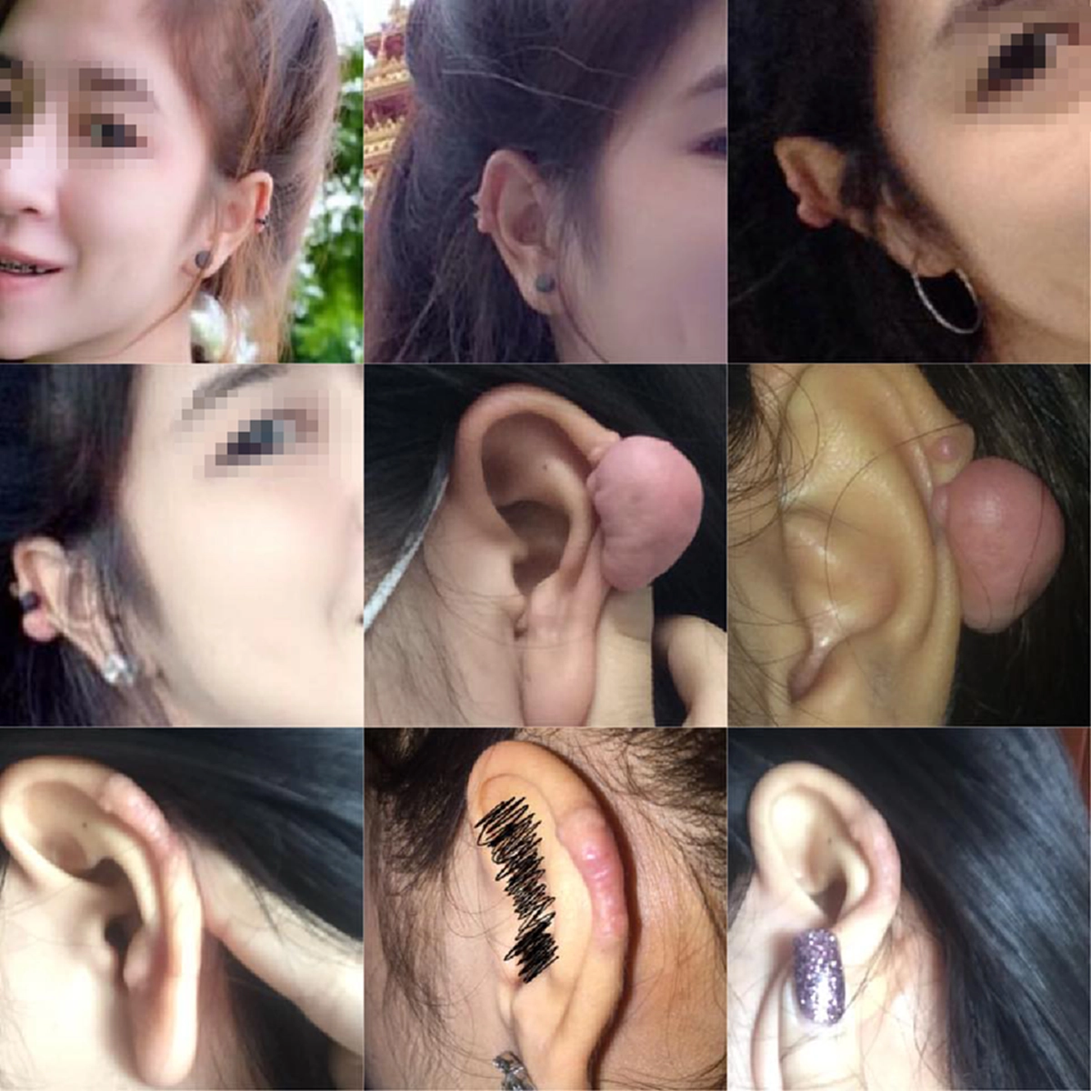 อุทาหรณ์สาวชอบเจาะ...จนเกิดเรื่องไม่คาดคิด! ก้อนเนื้อโผล่โตขึ้นทุกวัน....ใหญ่เป็นนิ้ว! ชาวเน็ตลั่นน่ากลัวมาก!?! (มีคลิป)