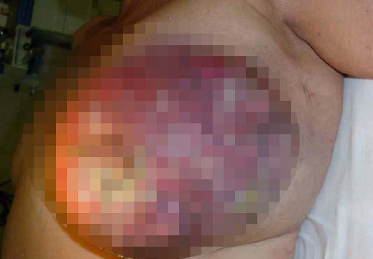 แพทย์เตือน!!! มะเร็งเต้านมเป็นได้ทั้งชายหญิง!!! ไม่อยากเป็นมะเร็งเต้านมต้องอ่าน!!!