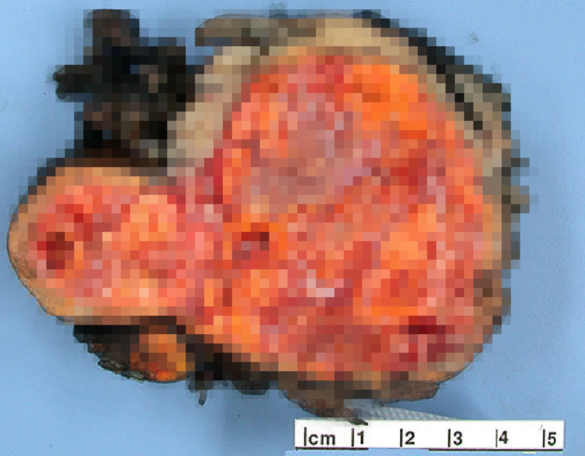 อย่ามองข้าม!!! มะเร็งสมอง ภัยร้ายที่ไม่คาดคิด เป็นแล้วเป็นอีกได้!!!