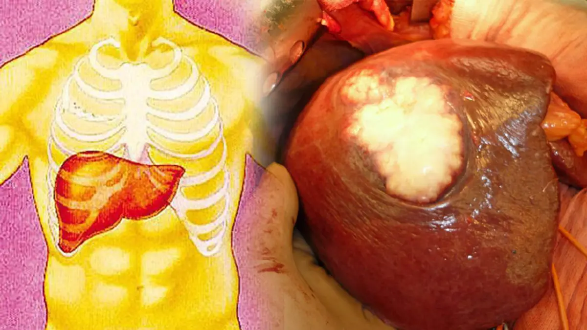 เตือนภัยมะเร็งตับลุกลามเร็ว!!! 10 สัญญาณเตือนโรคมะเร็งตับ เช็กก่อนอย่าปล่อยให้มะเร็งตัวร้ายทำลายสุขภาพ?!!!