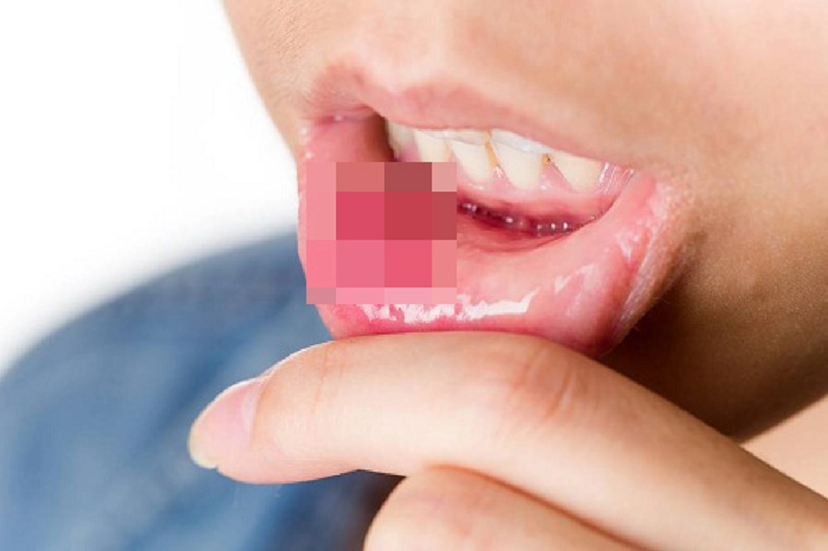 วิธีสังเกต แผลในช่องปาก อาจจะไม่ใช่แค่ร้อนใน มันอาจเป็น "มะเร็งช่องปาก"