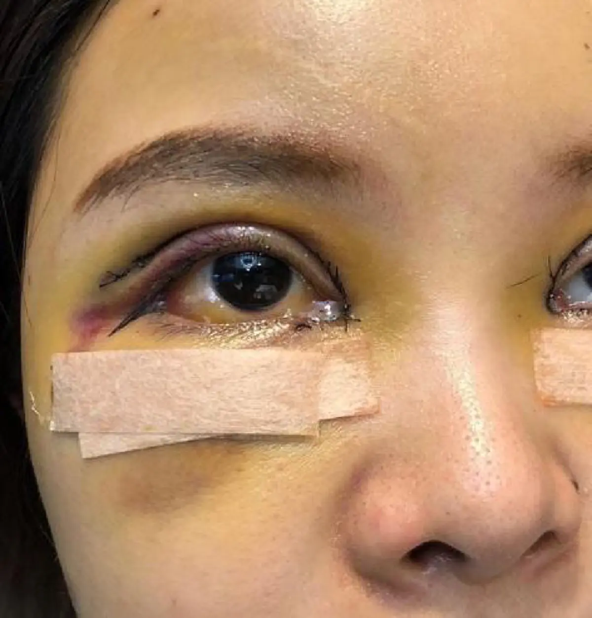 เริ่มดีขึ้นแล้ว! ส่องภาพ "หญิงแย้" อัพเดตร่างกายล่าสุด หลังทำศัลยกรรมทั้งตัว ไม่ได้อาบน้ำมา 15 วัน! (ชมคลิป)